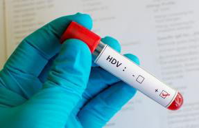 Image of Diapro Hepatitis D Virus (HDV) Antibody ELISA