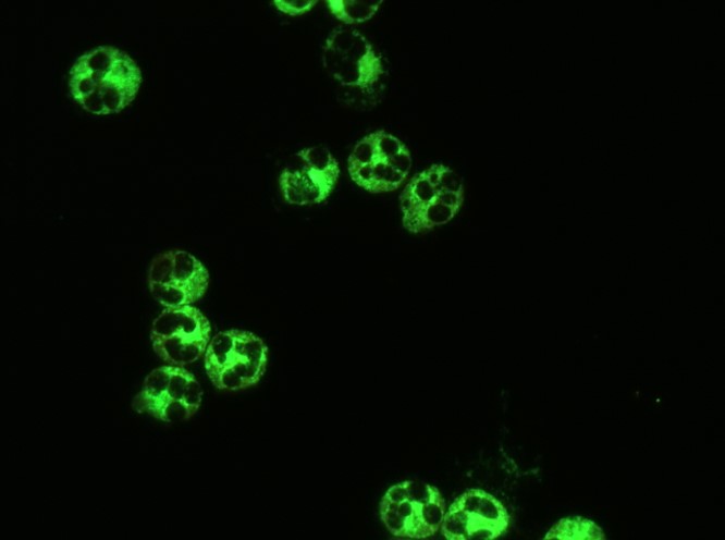 Image of Anti-Neutrophil Cytoplasmic Antibodies (ANCA)